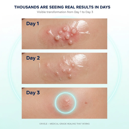 Dermelo™ Hydrocolloid Roll For Molluscum